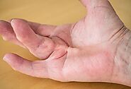 Treating the Early Stage Dupuytren's Contracture