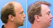 Website at https://dynamic8.ahlamontada.com/t2-factors-to-consider-before-hair-transplantation#2