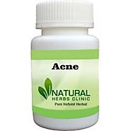 Herbal Treatment for Acne - Natural Herbs Clinic