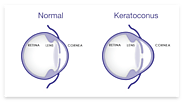 Keratoconus: It’s Treatment, Causes & Symptoms | Eyemantra Hospital