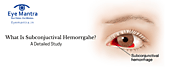 What Is Subconjunctival Hemorrgahe? : A Detailed Study