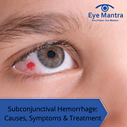 Subconjunctival Hemorrhage: Causes, Symptoms & Treatment