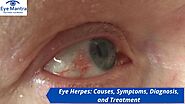 Eye Herpes: Causes, Symptoms, Diagnosis, and Treatment