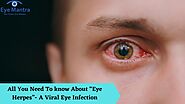 All You Need To know About “Eye Herpes”- A Viral Eye Infection