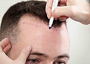 Hair Loss Treatment in Dubai, Abu Dhabi & Sharjah | Men & Women