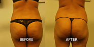 Brazilian Butt Lift - Young Medical Spa - Free Consultation!