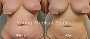 Natural Breast Augmentation - Young Medical Spa - Free Consultation!