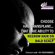 Chose Hair Transplant in Indore for Your Bald Scalp