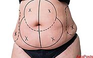 Large Volume Liposuction Safety and Indications - AsiaPosts