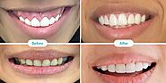 Amazing Benefits Of Gum Recontouring