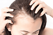 PCOS [Polycystic Ovarian Syndrome]-induced Hair Loss & What You Can Do – Nina Ross Hair Therapy