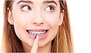 Dental Braces in Dubai & Abu Dhabi - Teeth Braces | Metal & Ceramic Cost