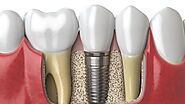 Dental Implant Surgery In Michigan: More Comfortable And Faster Resolutions | By Platinum Dental Care | Tealfeed