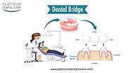 Everything You Need To Know About Porcelain Bridge And Its Benefits