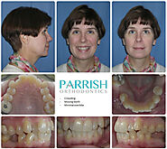 Parrish Orthodontics Before and After Photos