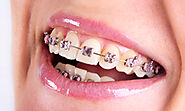 Types of Braces | Parrish Orthodontics