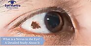 What is a nevus in the eye? : A Detailed Study About It