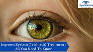 Ingrown Eyelashes (Trichiasis) Treatment : All You Need To Know