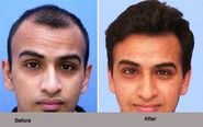 Suffering from Baldness? Get the Best Hair Transplant In India
