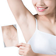 Trends In Laser Hair Removal For Men – Rija’s Blog