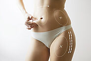 5 Things No One Will Tell You About Liposuction - Dynamic Clinic