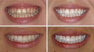 The Best Of The Best Teeth Whitening