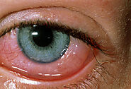 Treatment for Eye Allergies - Philadelphia Holistic Clinic - Dr. Tsan & Assoc.