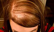 Treatment for Hair Loss - Philadelphia Acupuncture Clinic - Dr. Tsan & Co.