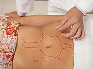Acupuncture For Weight Loss | Acupuncture and Weight Loss