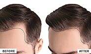 Hair Loss Treatment Cost for Men in Noida | Hair Fall Doctor in Noida