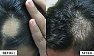 Hair loss in males? Can PRP help?