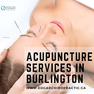 Effective Acupuncture Treatment in Burlington