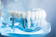 What are the Advantages of Dental Implants?