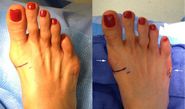 New Scarless Bunionectomy or minimally invasive bunion surgery is possible via selective surgeons.
