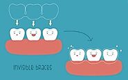 Ceramic Braces - Conveniently Acquiring A Great Smile