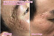 Get The Best Acne Scar Treatment In Singapore