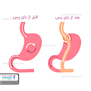 هر آنچه که باید درباره عوارض جراحی لاغری بای پس معده بدانید - کلینیک فوق تخصصی لاغری