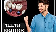 What is a Dental - Teeth Bridge Procedure?