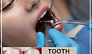 🦷 Teeth Gap Filling In Hyderabad India