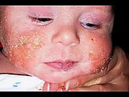 Natural remedies for babies with eczema - Philadelphia Homeopathic Clinic