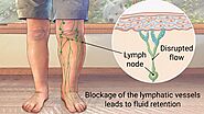 Treatment for Lymphedema - Philadelphia Holistic Clinic - Dr. Tsan & Assoc