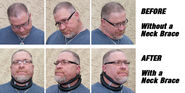 How A Cervical Neck Brace Is Used To Treat Neck Pain From Cervical Dystonia