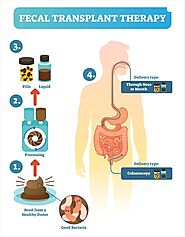Fecal Microbiota Transplant for Relapsing Clostridium difficile Infection Using a Frozen Inoculum From Unrelated Dono...