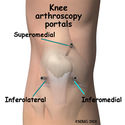 Knee Surgeons: Knee Arthroscopy
