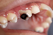 How to know if cavity is deep ?