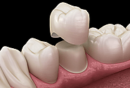 Ceramic braces price in India