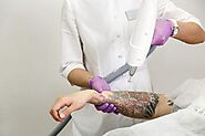 Tattoo Removal? Lizard’s Skin Tattoos are Offering The Best Treatments!