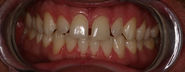 West Lafayette, Indiana Dentist - Dr. Donald L. Swoverland, Family Dentistry, TMJ Treatment, Headache Treatment, Invi...