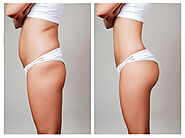 Brazilian Butt lift | Fat Transfer to Butt - Dr. Claudine Roura