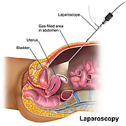 Laparoscopy Procedure Details, Safety, Cost & Recovery